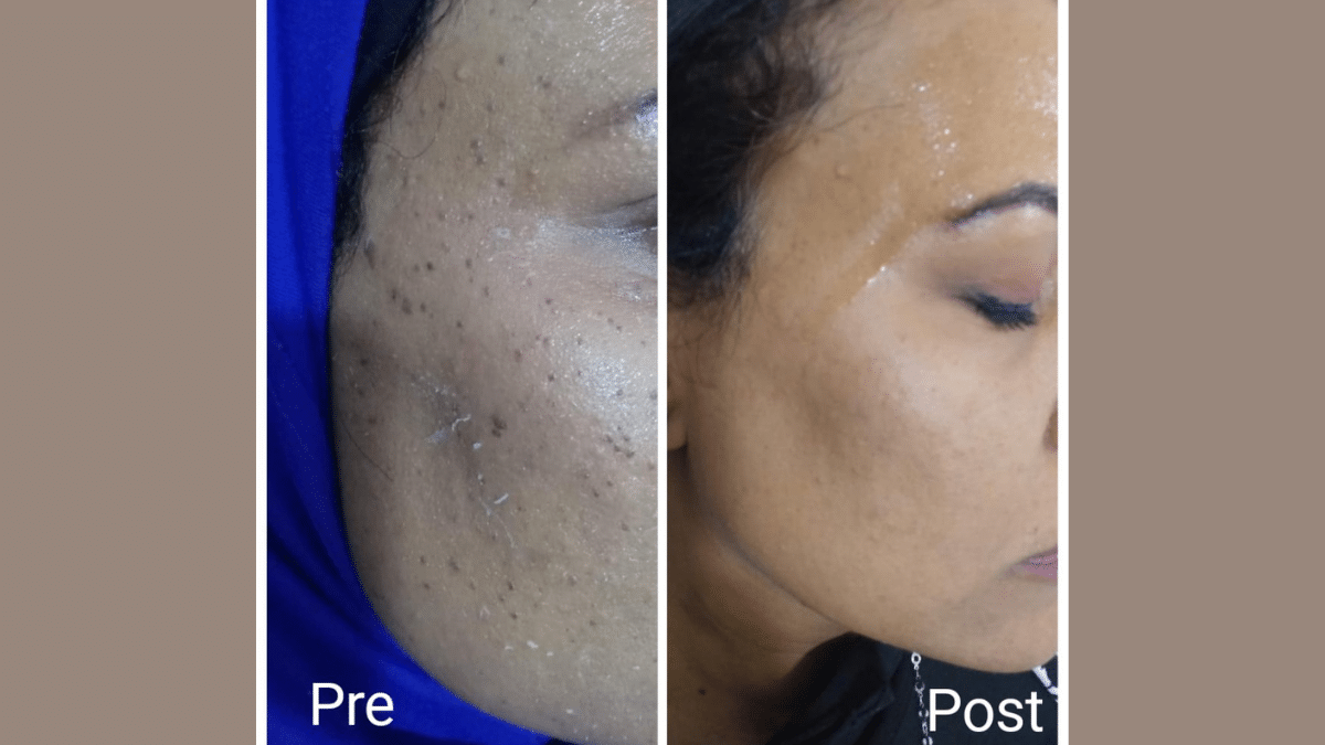 Skin tag removal in Hurghada